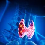 Thyroid gland with nodules inside human body - 3D illustration